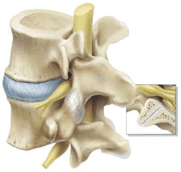 Facet Arthropathy