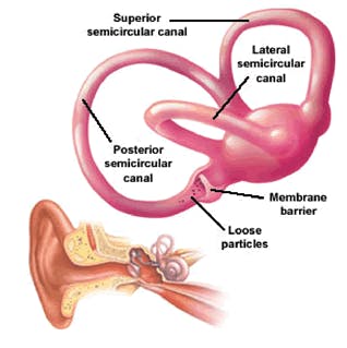 Positional Vertigo