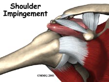 Shoulder Impingement