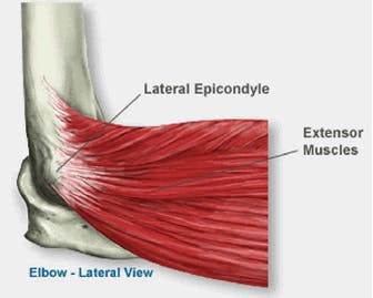 Tennis Elbow