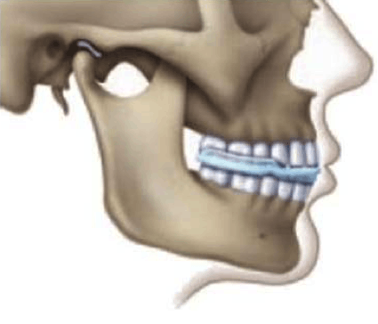 Description: skeletal illustration of cranio-facial pain