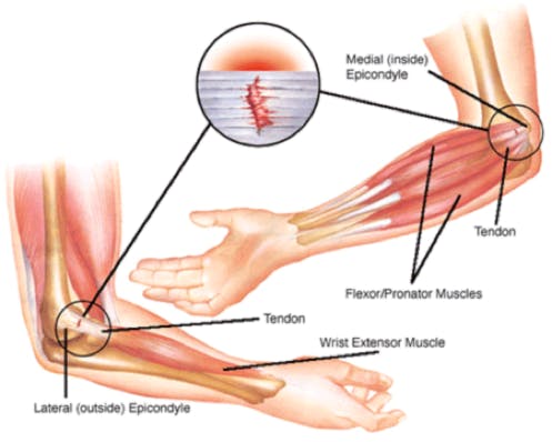 Golfer's Elbow