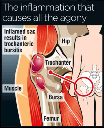 Illustration of hip bursitis